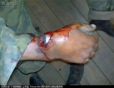 hand-20accident1.jpg