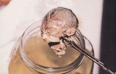 abortedbaby3.jpg