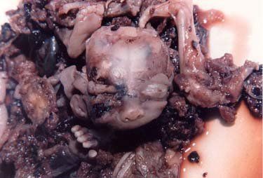 abortedbaby5.jpg