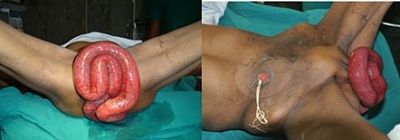 vaginal-evisceration-following-anterior-pelvic-exenteration.article-g01.fs.jpg