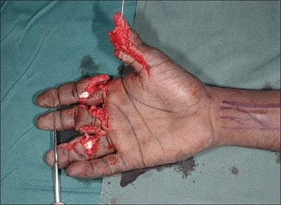 handinj.jpg