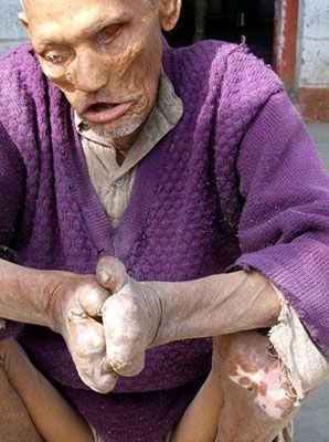 leprosy.jpg