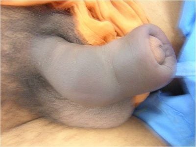 penis-20fracture.jpg
