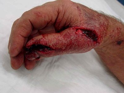 lawnmower-injury-sm-sick-su.jpg