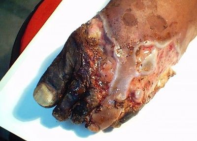 foot-20infection1.jpg