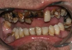 austin_rotten_teeth.jpg