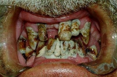 meth-teeth-8.jpg