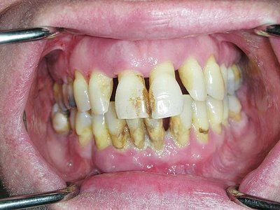 teeth.jpg