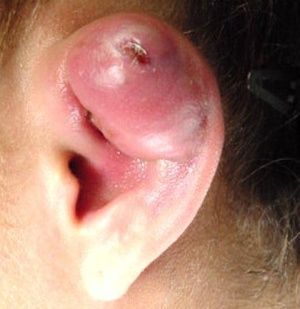 infected-ear-piercing-2.jpg