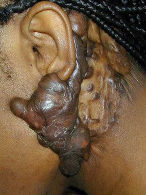 Perichondritis: Pictures of Infected Ear Piercings and Earlobe Keloids - Piercing infection 2