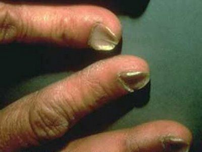 Spoon-Nail-2.jpg