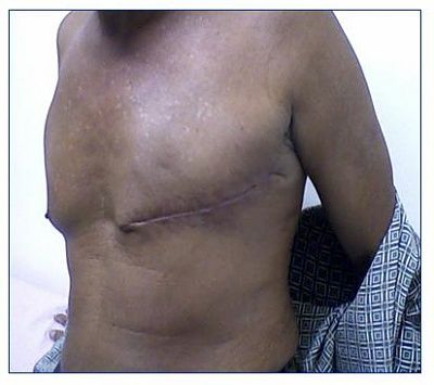 male-breast-cancer-2.jpg