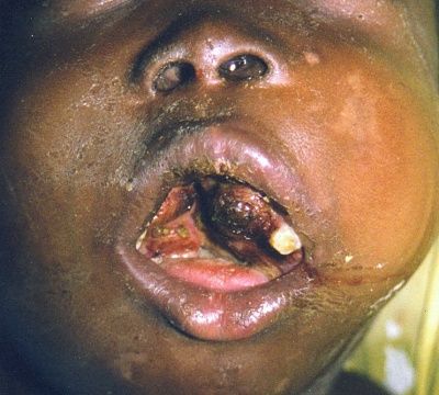 lymphoma-1.jpg