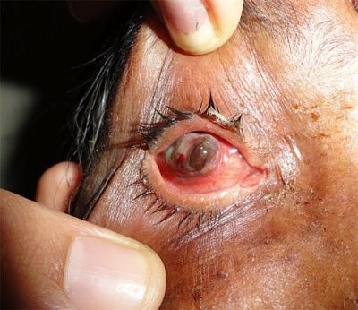 prolapsed-20iris.jpg