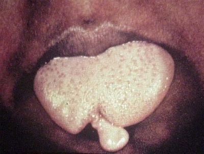bifid-20tongue.-20a-20structural-20defect-20of-20the-20tongue-20in-20which-20the-20extremity-20i.jpg