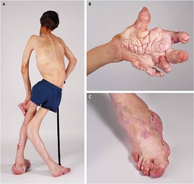 proteus-20syndrome-2c.jpg