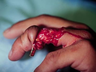 degloving.jpg