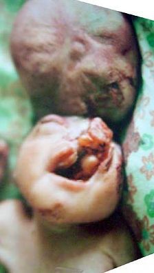 Exencephaly.jpg