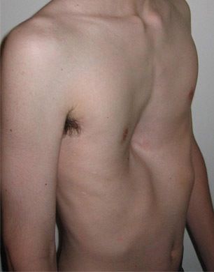 Pectus%20excavatum.jpg