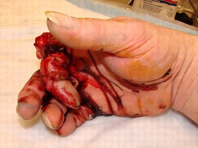 broken-20finger.jpg