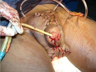 elephantiasis-2.jpg
