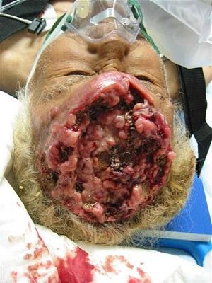 brain-cancer-1.jpg