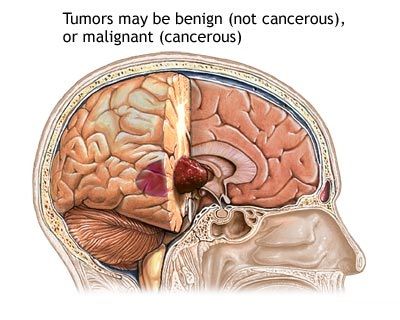 Brain-Cancer-6.jpg