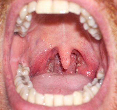 Oral-Infection-6.jpg