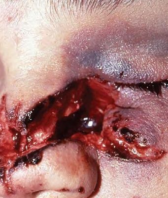 torn-20nose.jpg
