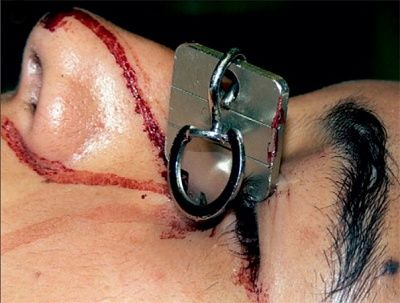 penetrating-20injury-20to-20the-20orbit1.jpg