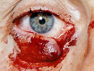 eyelid%20laceration%20400.jpg