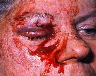 eyelid%20laceration%20401.jpg