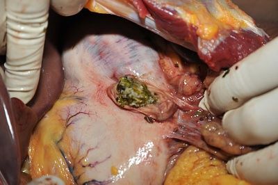 vegetables-20leaking-20from-20a-20stab-20wound-20to-20the-20stomach..jpg