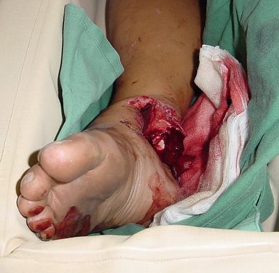 ankle.jpg