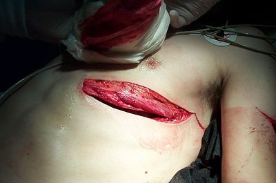 chesttrauma.jpg