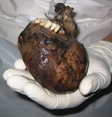 teratoma-1.jpg
