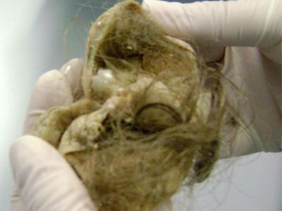 teratoma.jpg