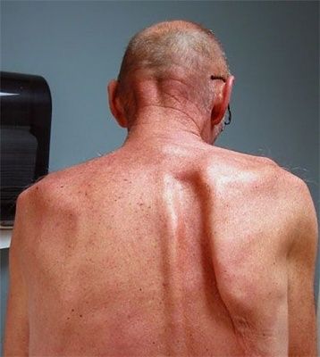 shoulder-20blade.jpg