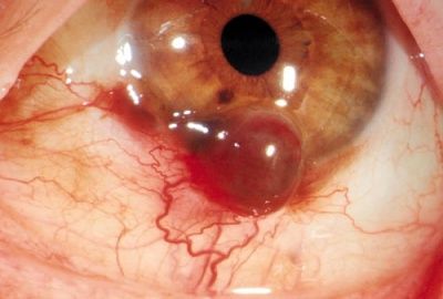 conjunctival-20tumor.jpg