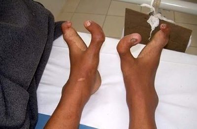 ectrodactyly.jpg