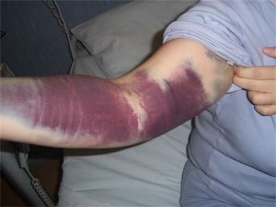 hematoma-20resulting-20from-20a-20blood-20transfusion.jpg