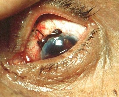 iris-20prolapse-20resulting-20from-20an-20injury.jpg
