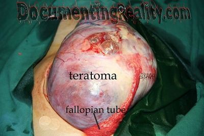 immature-teratoma-2-07-007-small.jpg