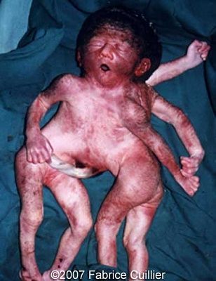 cephalothoracopagus-twins.jpg