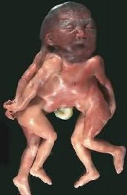conjoined_twins.jpg