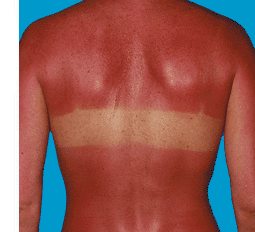 sunburn-20-281-29.gif