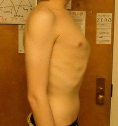 pigeon-chest.jpg