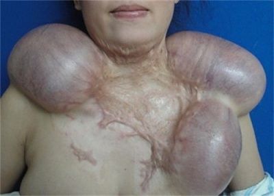 tissue-20expansion.jpg