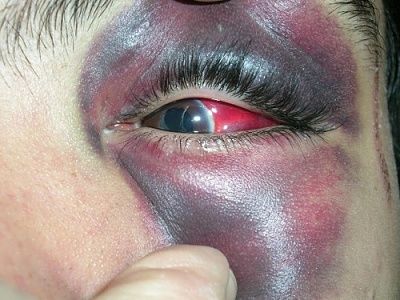 black-20eye.jpg