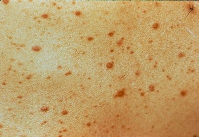 hiv-rash.jpeg